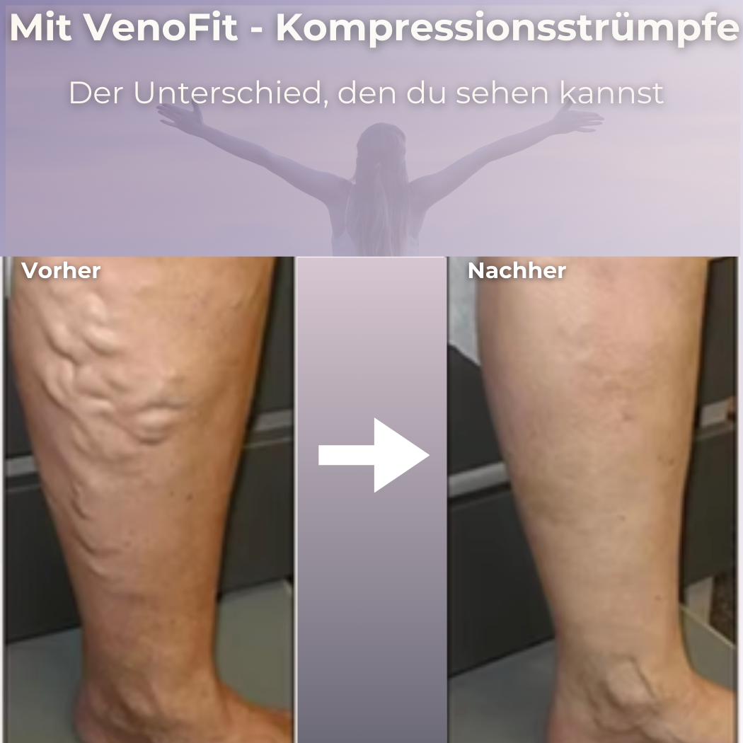 VenoFit –  Medizinische Kompressionsstrümpfe